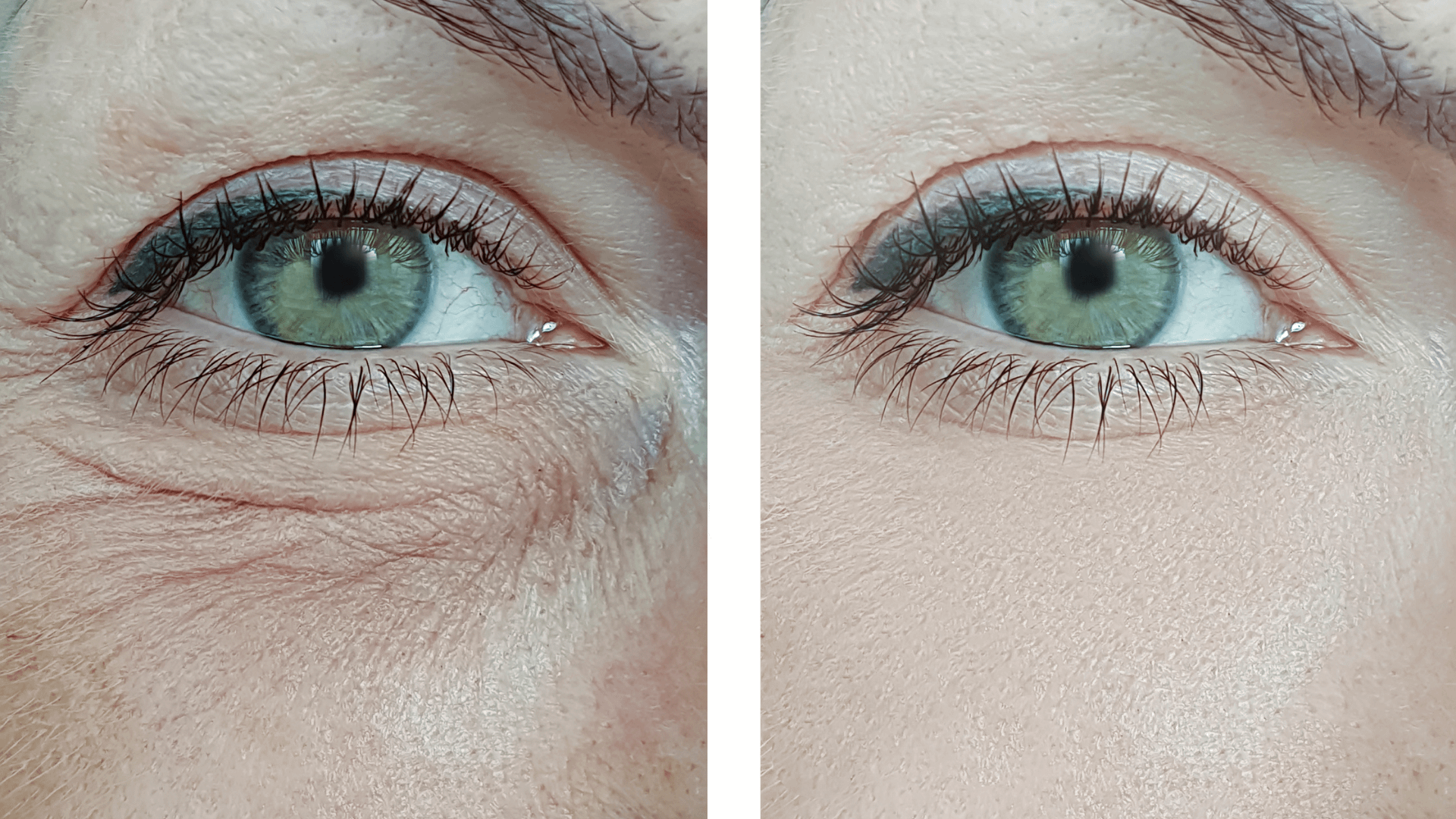 Eye Wrinkles Removal